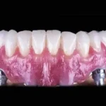 Dental Implants Vs. Dentures – Which Is Better For You?