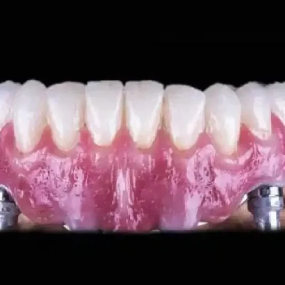 Dental Implants Vs. Dentures - Which Is Better For You?